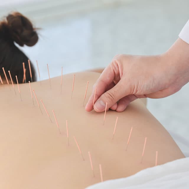 Experto en acupuntura en Santiago de Compostela